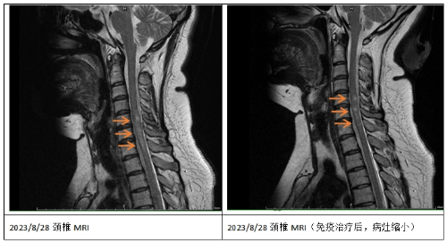 瑞金病例丨罕见病+免疫病，患病新娘在这里